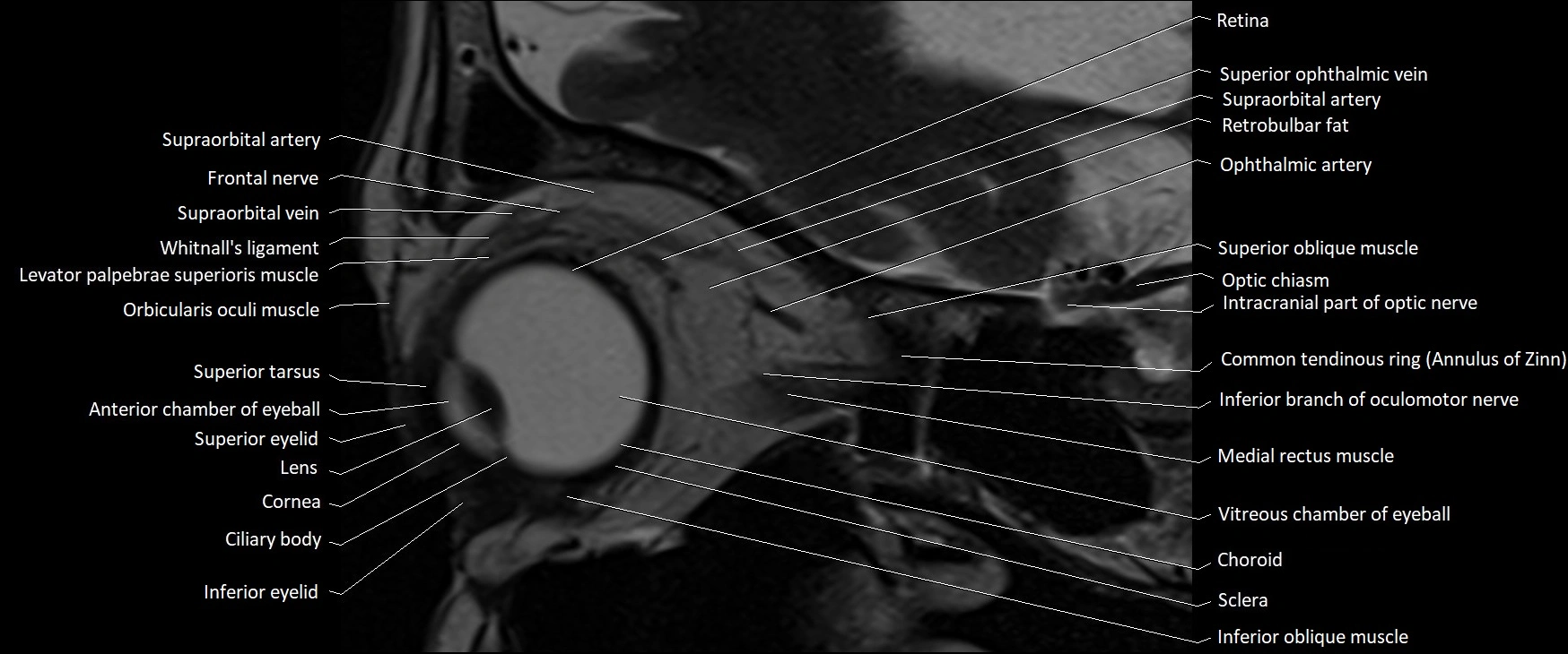 MRI Orbit sagittal cross sectional anatomy 3T image 7.webp